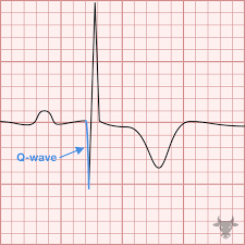 Image result for Q Wave