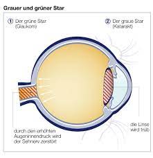 Grauer Und Gruner Star Was Ist Das Mit Docvadis