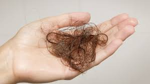 However, hair loss on the drug has been reported by many individuals. Wellbutrin Bupropion And Hair Loss Alopecia