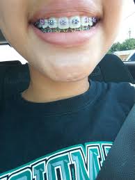Braces Colors Black And Blue Braces Braces Braquets Braces Colors Cute Braces Colors Braces Girls