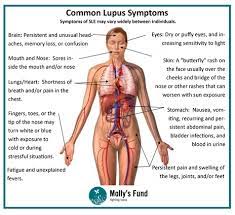 Molly S Fund Blog On Some Common Lupus Signs And Symptoms Click To Read More About This Topic Lupusarthritisremedies Lupus Facts Lupus Symptoms Lupus