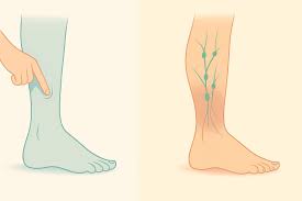 Image result for Edema Exam