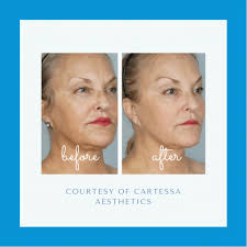 Tetra CO2 Laser & CoolPeel™ Now offered at our Med-Spa in Savannah