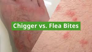 Image result for flea bites