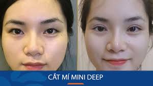 Cắt Mí Mini Deep: Giải pháp hoàn hảo cho đôi mắt một mí, sụp mí