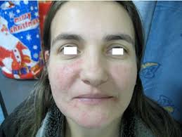 Image result for demodex rosacea