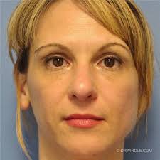 Dermal Fillers Before and After Photos by Brian Windle, MD; Aspen, CO