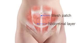 Umbilical Hernia Repair Mesh Umbilical Hernia Repair Umbilical Hernia Hernia Repair