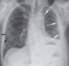 It is important to understand, however, that not every possible cause of damage is covered. Malignant Pleural Mesothelioma With Pleural Plaques A Case Report