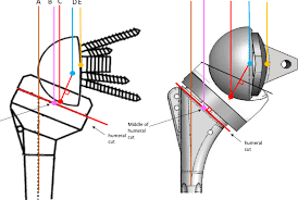 Мемфис депай, фото нападающего футбольного клуба олимпик лион на readfootball.com. Templates Of A Medialized Implant Delta Iii Depuy Warsaw In And Download Scientific Diagram