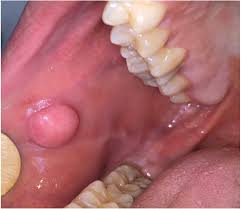 Image result for Labial mucosa