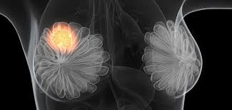 Check spelling or type a new query. The Early Breast Cancer Trialists Collaborative Group Ebctcg Clinical Trial Service Unit Epidemiological Studies Unit Ctsu
