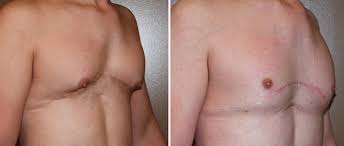 Plastic Surgery Case Study Custom Sterno Pectoral Implant For Secondary Aesthetic Deformities From A Prior Pectus Excavatum Repair Explore Plastic Surgery