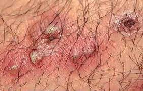 Then, use a lubricating shave cream or gel, or one that's created for sensitive areas, when shaving. Cluster Of Ingrown Hairs On Face Ingrown Hair