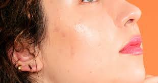 Laxity of the mid to lower face can increase the visibility of deep mental creases on the chin. Orange Peel Skin Pores Texture Treatment