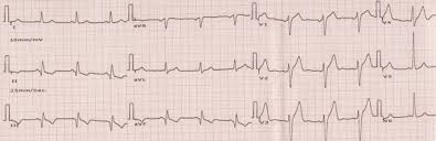 Image result for Q Wave