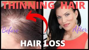 There are two main types of alopecia, and then a variety of forms of hair loss. Fix Thinning Hair Bald Spots In Seconds Female Hair Loss Mature Beauty Over 40 Youtube