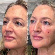 Cydney Brown BSN, RN (@cosmeticnursecydney) • Instagram photos and videos