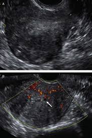 Symptoms include heavy periods, severe cramping and infertility. Adenomyosis A Life Cycle Approach Reproductive Biomedicine Online