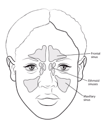 Lateral wall tumors destroy the medial maxillary sinus wall. What Are Nasal Cavity And Paranasal Sinus Cancers