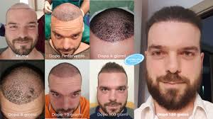 Signing out of account, standby. Auto Trapianto Fue