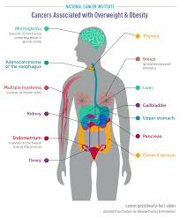 Discomfort in the upper abdomen on the right side. Obesity And Cancer Fact Sheet National Cancer Institute