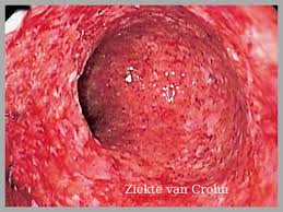 De ziekte van crohn is een chronische ontstekingsziekte aan de darmen. Ziekte Van Crohn Maag Darmaandoeningen