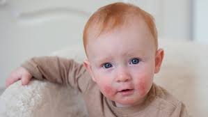 Alternative Treatment for Allergies