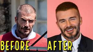12,00 m €* may 6, 1990 in budapest, hungary. David Beckham S Amazing Hair Loss Transformation Did He Get A Hair Transplant