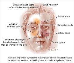 Acute Rhinosinusitis Core Em