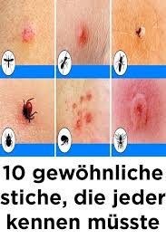 10 Gewohnliche Stiche Die Jeder Kennen Musste Gewohnliche Jeder Kennen Musste Stiche Gesundheit Fersensporn Hausmittel Stiche