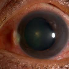 Image result for Ciliary Flush