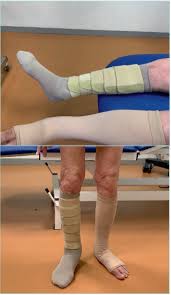 Image result for Lipodermatosclerosis