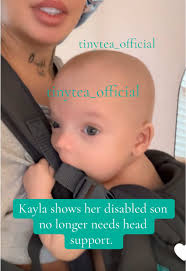 Cranial Facial Dysplasia Kayla Brother