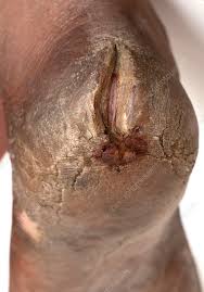 Image result for Leprosy