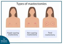 Image result for Mastectomy