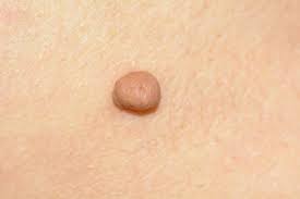 Fibrom Ursachen Beschwerden Therapie Gesundpedia De