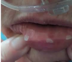 A bump on the roof of the mouth can be worrisome, especially if it does not go away quickly. Possible Signs Of Covid 19 In The Mouth