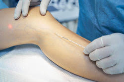 Varicose Vein Treatments | Spider Veins Clinic in Dubai