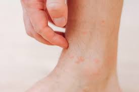 Image result for allergy rash on the legs