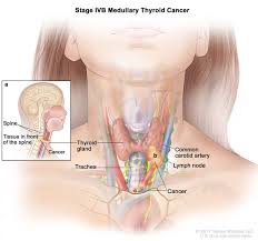 Thyroid anatomy, thyroid physiology, thyroid, thyroid gland. Definition Of Stage Iv Medullary Thyroid Cancer Nci Dictionary Of Cancer Terms National Cancer Institute