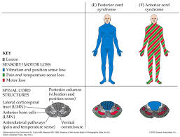 The Anterior Spinal Artery Supplies The Ventral 2 3 Of The Spinal Cord Whereas The Posterior Spinal Artery Supplies The Spinal Cord Lesions Spinal Cord Spinal