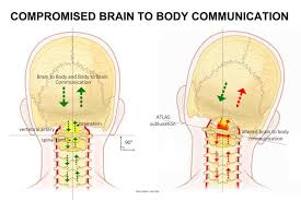 Image result for Postconcussion Syndrome