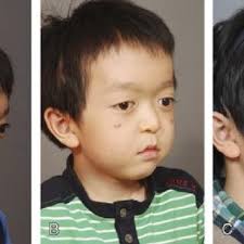 This patient was corrected with an external distractor, which was...