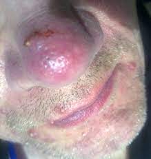Die erkrankung ist durch einen chronischen und schubartigen verlauf gekennzeichnet und wird durch ein genetisch prädisponiertes, multifaktorielles geschehen bedingt. Rosacea Wikiwand