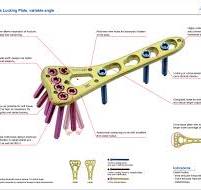 Distal Radius Locking Plate Ⅰ,Variable Angle,Medical Device ...