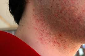 Difference Between Razor Burns Razor Burn Remedies Shaving Bumps