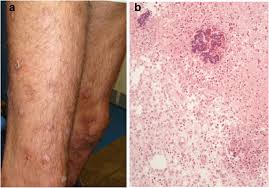 Image result for Panniculitis