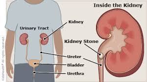 kidney stones for teens nemours kidshealth