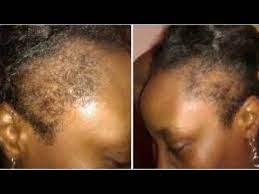 Como Usar Jugo De Cebolla Y Aceite De Ricino Para Repeler Los Bordes Calvos Youtube Castor Oil For Hair Growth Castor Oil For Hair Onion Juice